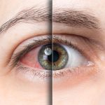 Dry Eye Syndrome Demystified: Shedding Light on a Common Ocular Condition